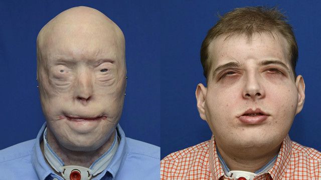 151117101720_face_transplant_640x360_reuters_nocredit_thumbnail.jpg