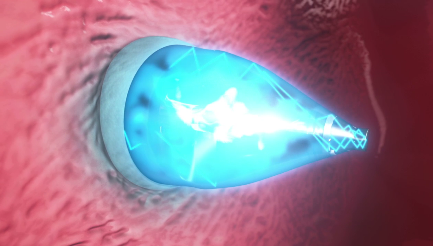 photo of UV-light enabled catheter fixes heart defects without surgery image