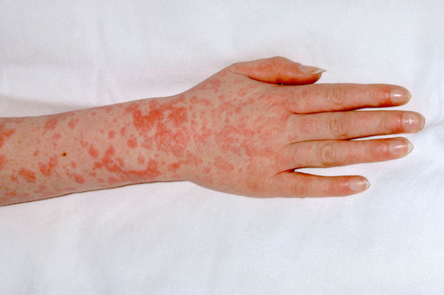 What Is Scarlet Fever?