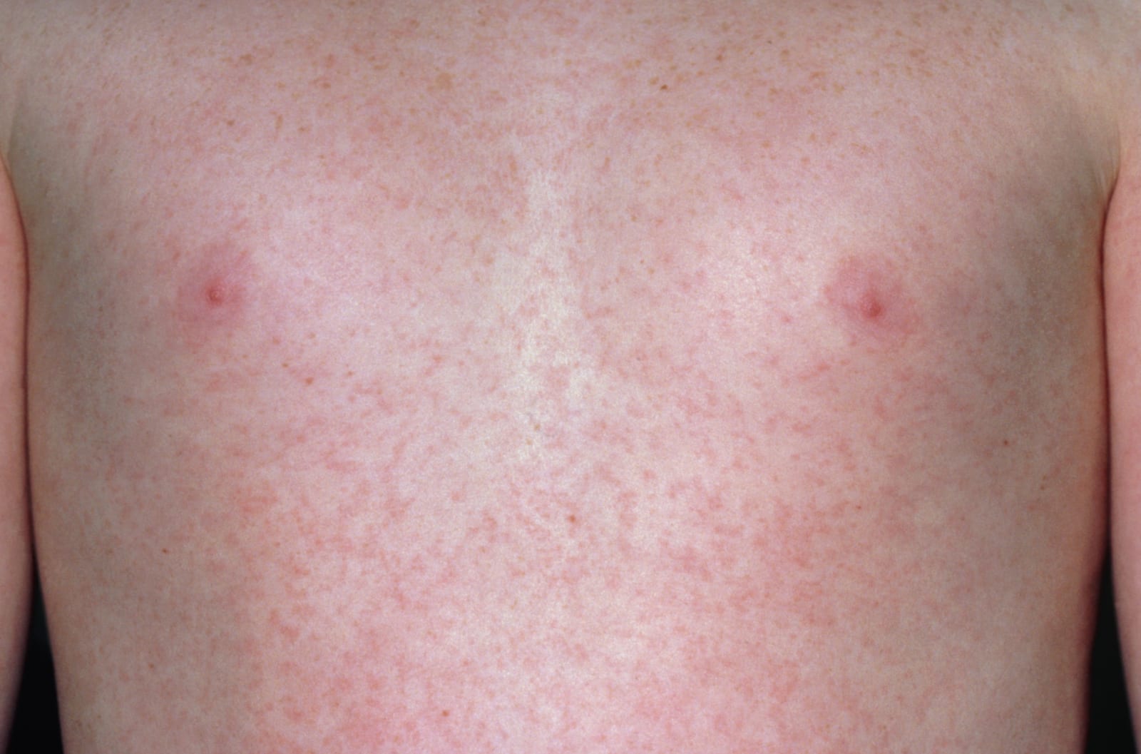 German measles (Rubella) rash on chest of a child