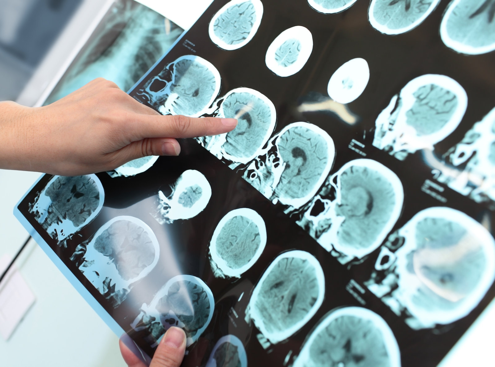 Implantes ultrasónicos para atacar mejor los tumores cerebrales