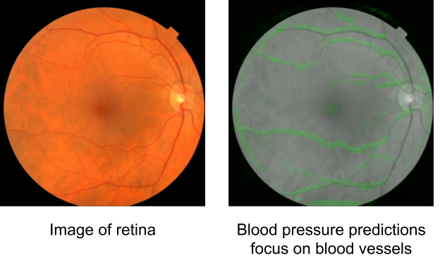On the left: a sample retinal image from the dataset in color. On the right: attention map indicating areas that support the prediction for high systolic blood pressure in green, which overlap with the retinal blood vessels.