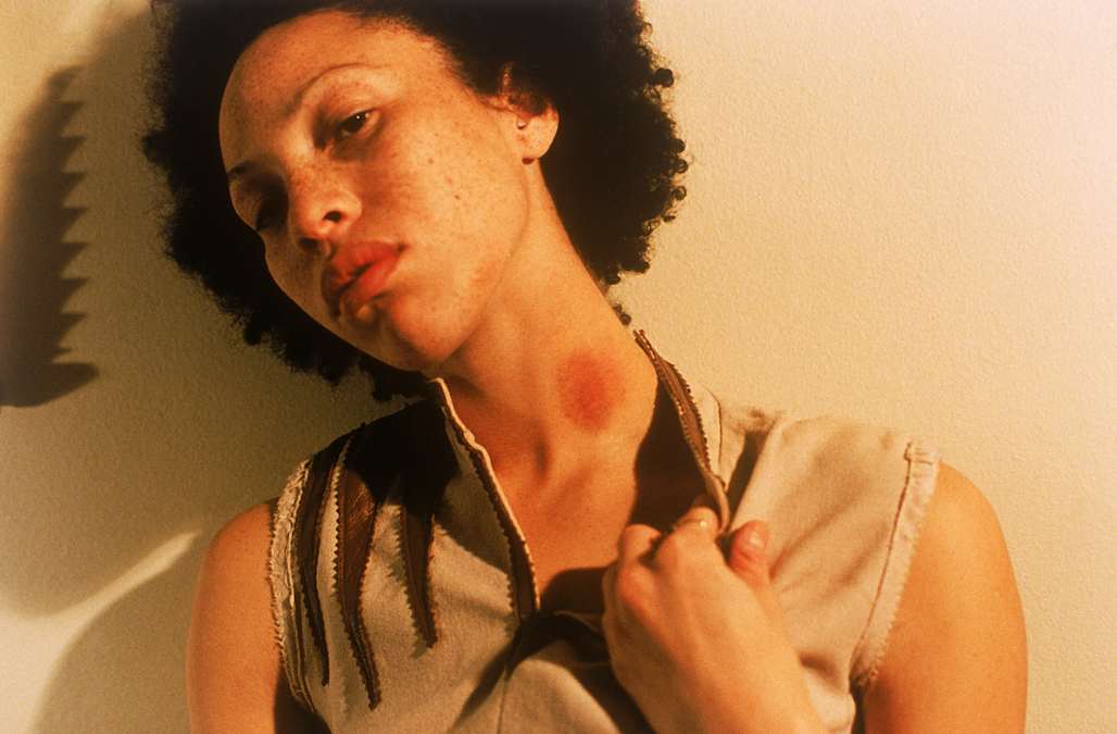 Can You Really Die From A Hickey 