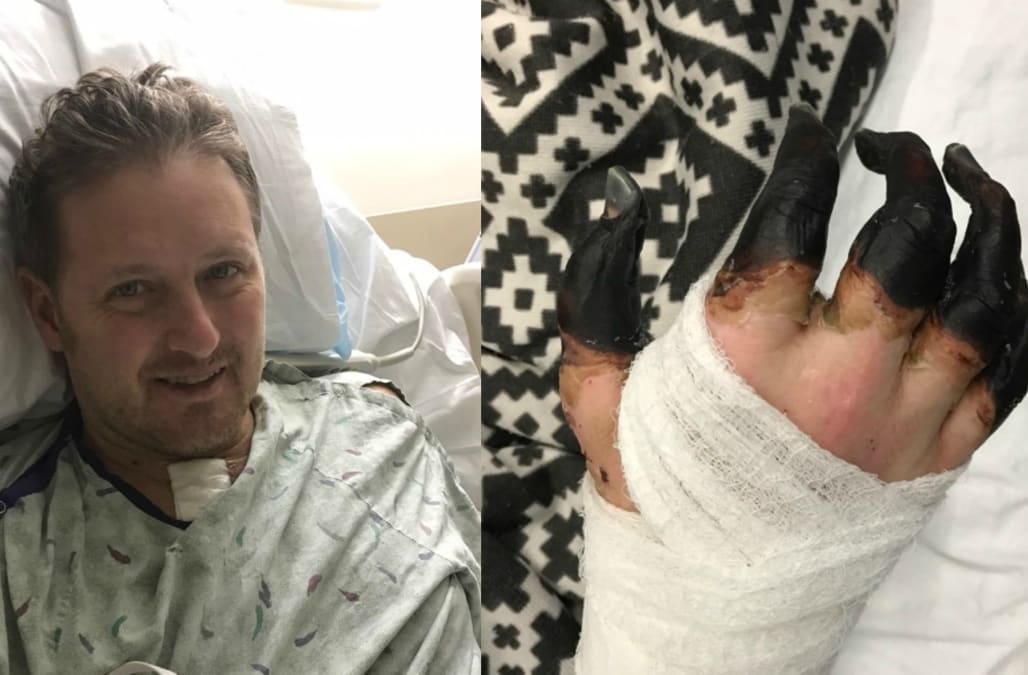 Mans Hands And Feet To Be Amputated After Strep Throat Infection Aol 