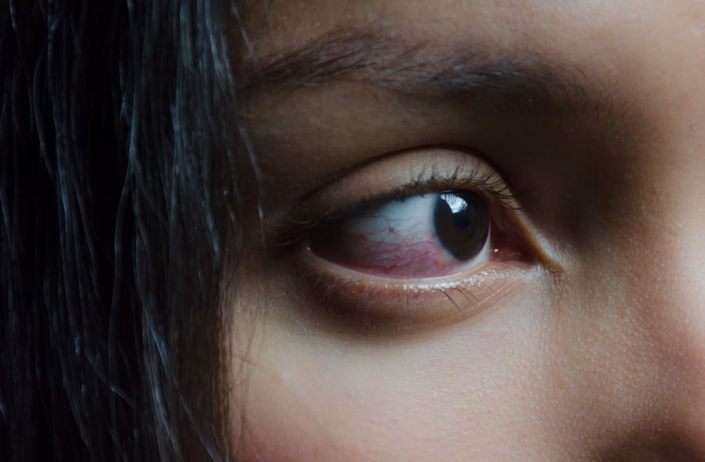 Can you change your eye color? Procedures carry big risks