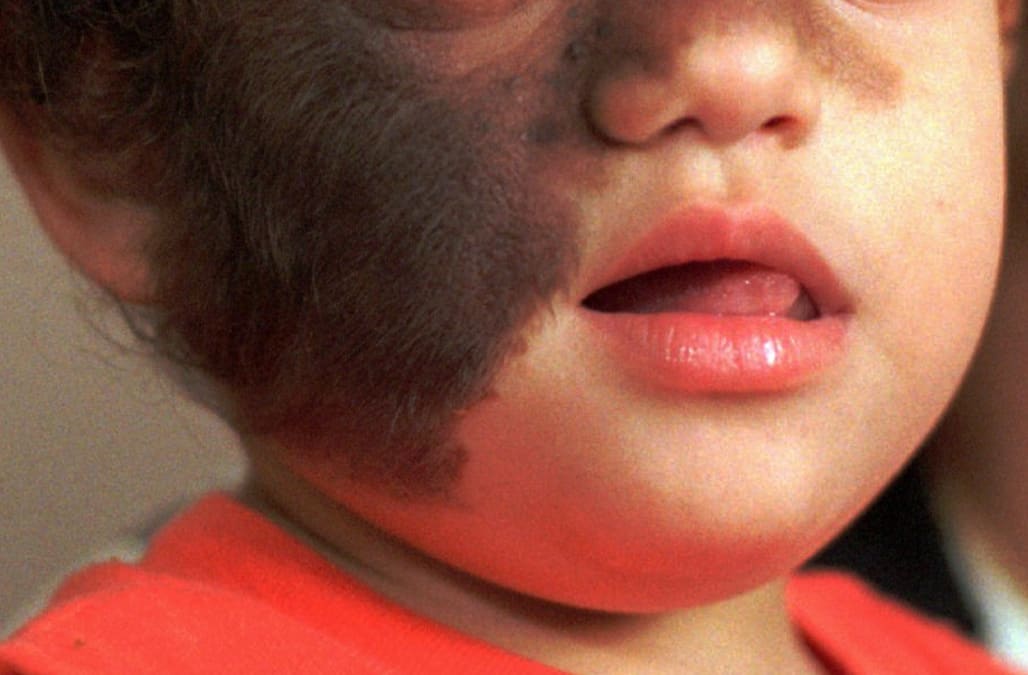 hypertrichosis baby