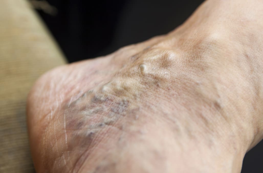 Incredibly Simple Ways To Fight Varicose Veins And Spider Veins