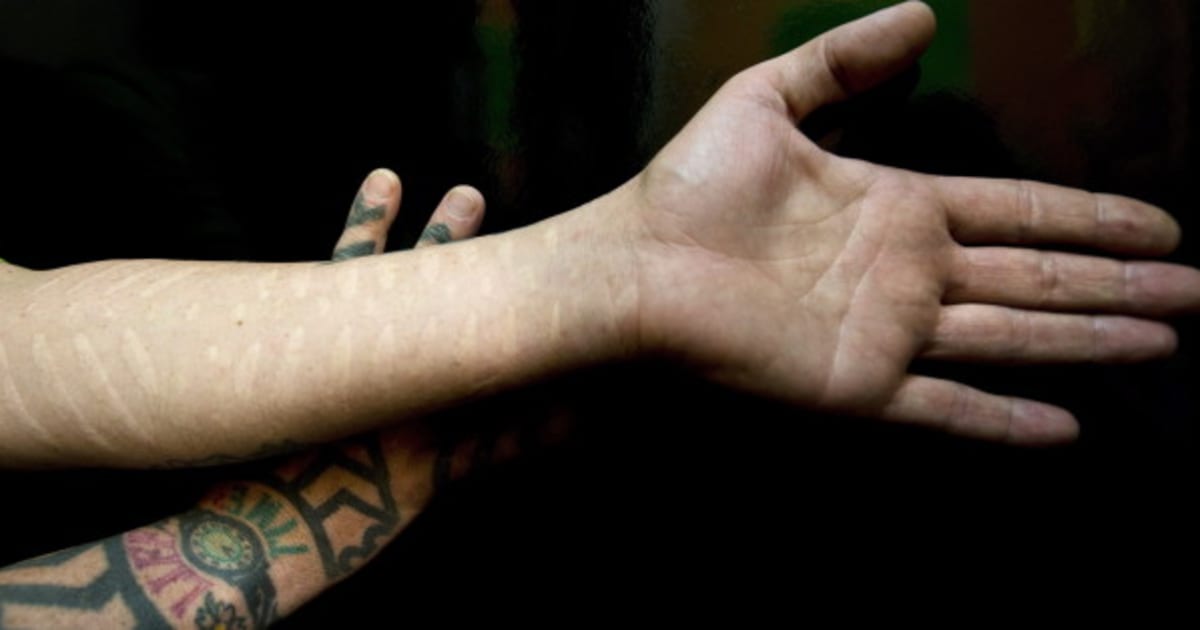 Scarification: les cicatrices plutôt que le tatouage ou le perçage