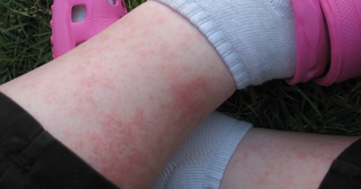 When Does Heat Rash Go Away On Babies