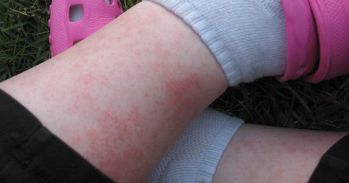 What Does A Heat Rash On The Elbow Look Like? – UTXHF