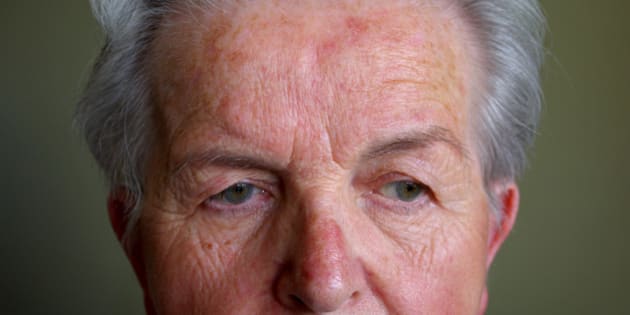 Why Rosacea Affects Those Who Show Symptoms