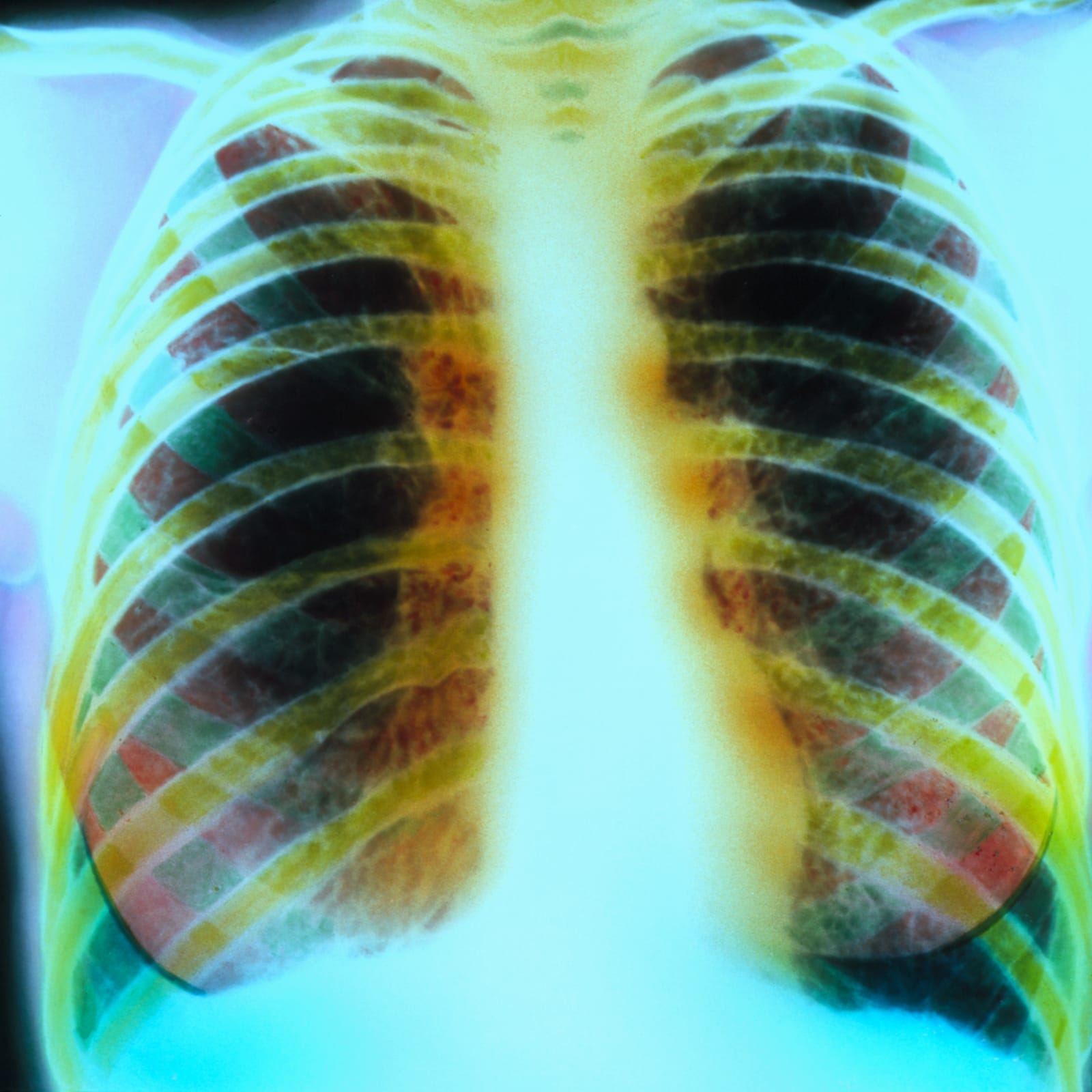 Chest X-ray of lungs with cystic fibrosis