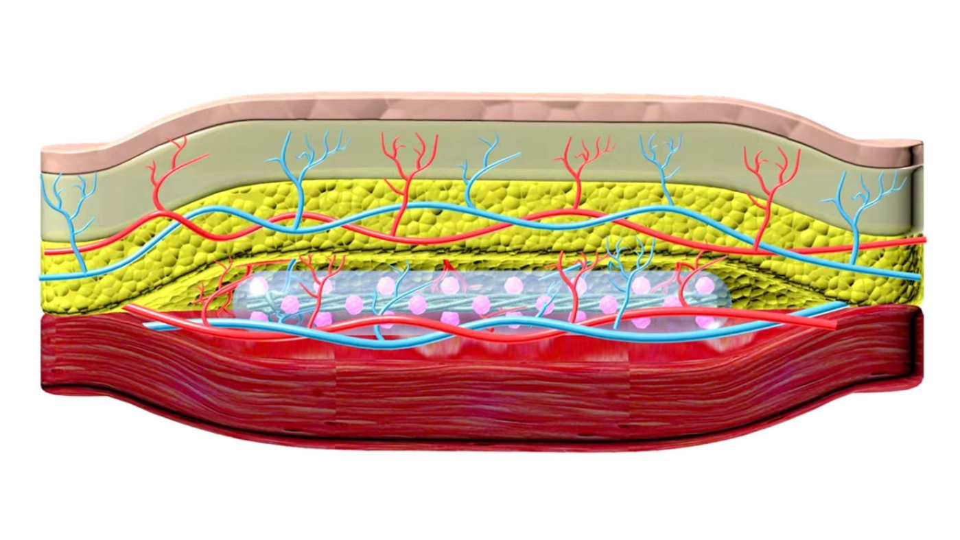 Researchers develop under-the-skin implant to treat Type 1 diabetes