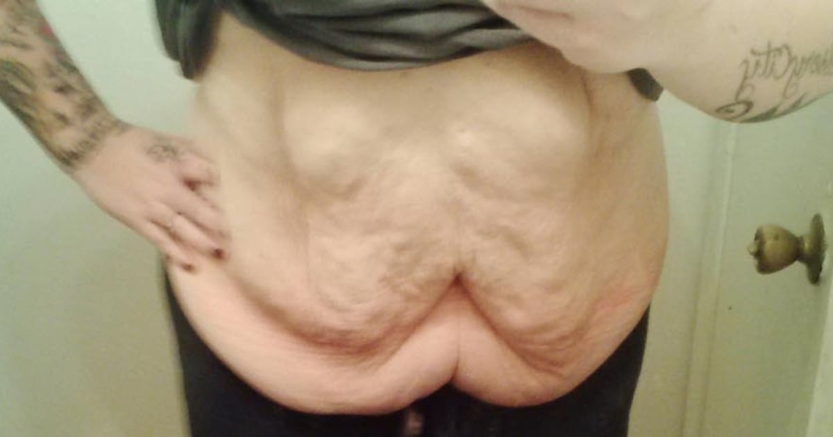 These Photos Show The Problem With Excess Skin After 