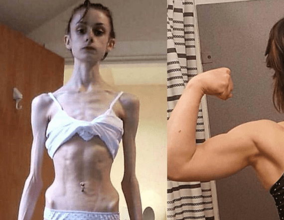 Anorexia survivor shares amazing recovery photos.